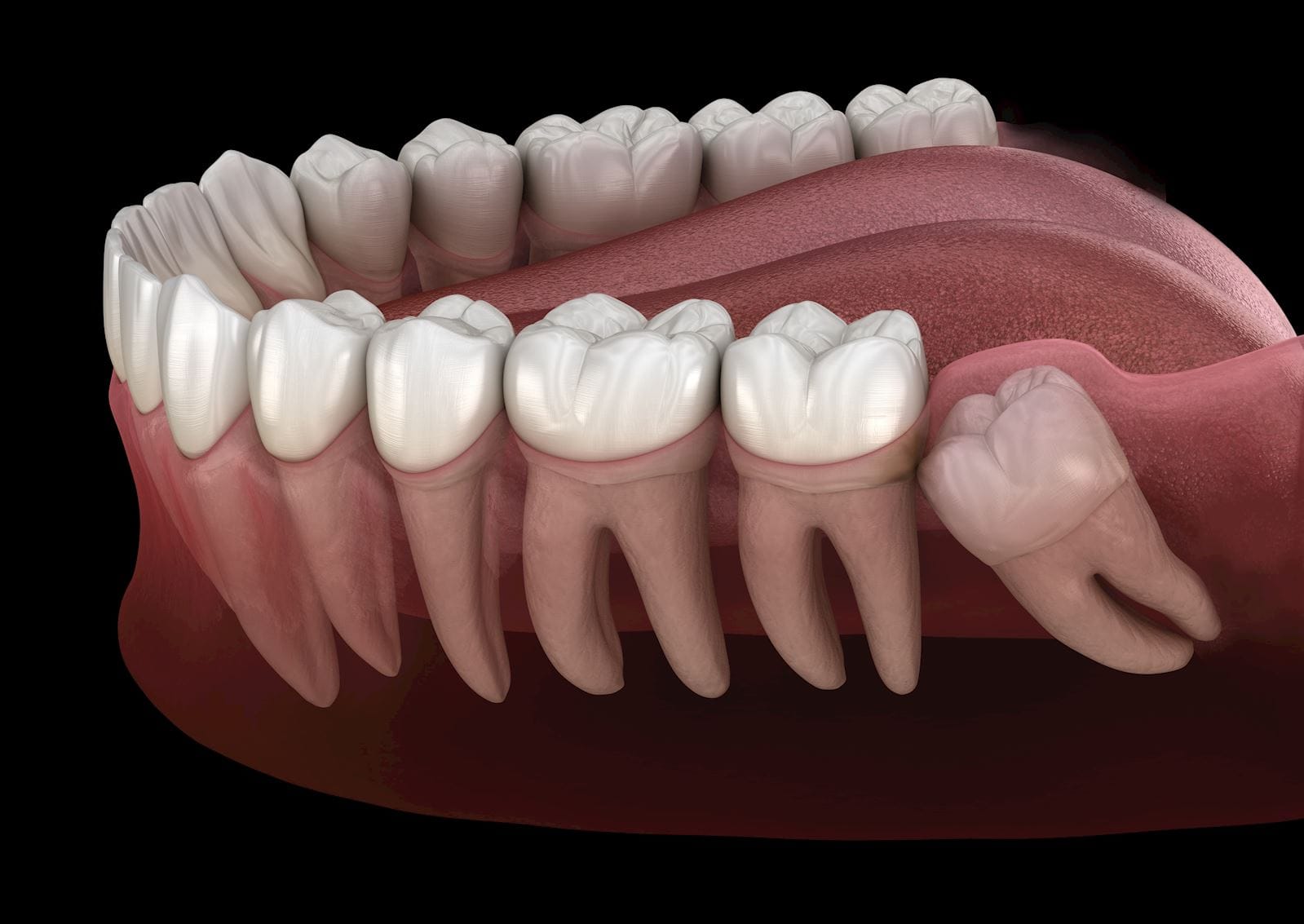 rendering of wisdom tooth under the gum pushing into another tooth